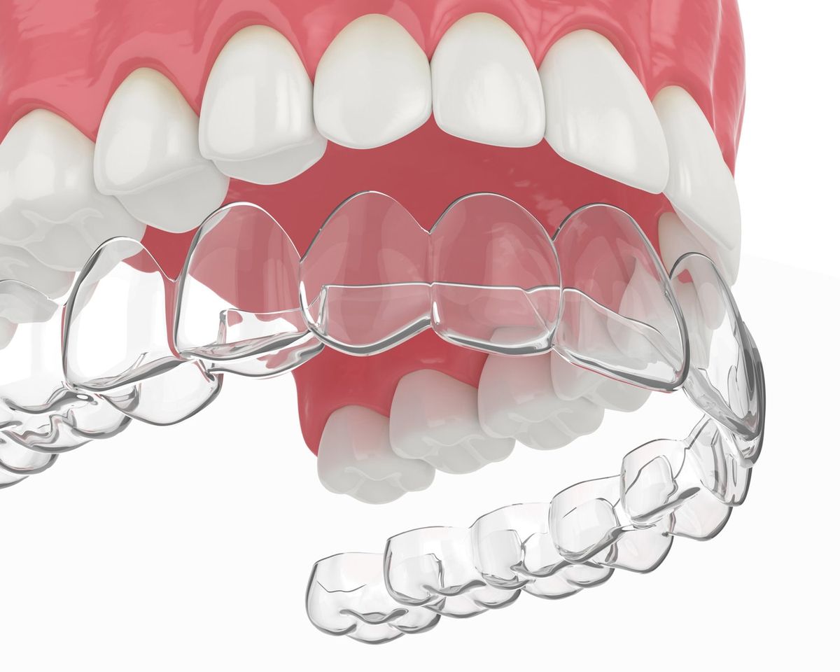 Niềng răng invisalign